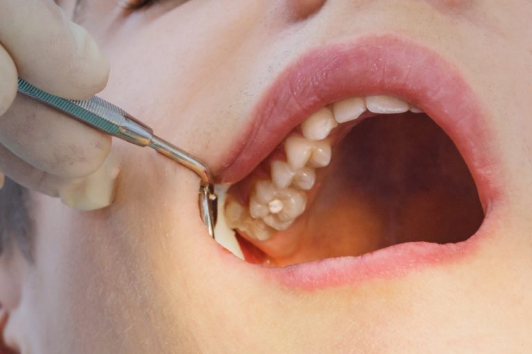 googong-dental-teeth-filling